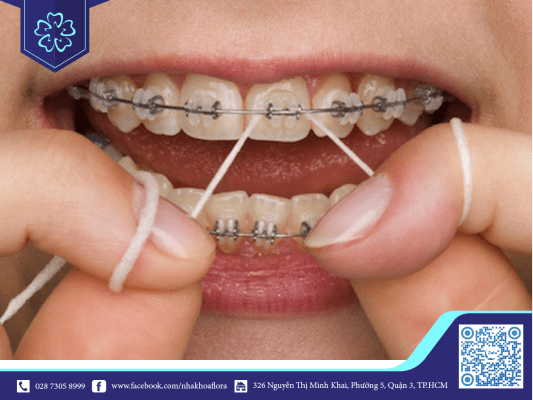 roast-de-nga-vang-khi-nieng-roast Teeth that are easy to recline gold when braces