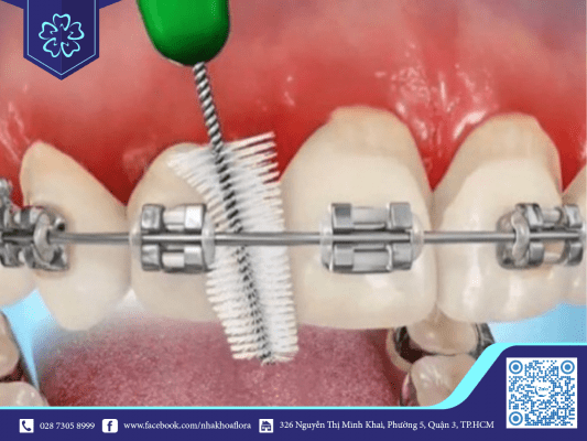 de-bi-viem-nuou-neu-nieng-rang-khong-duoc-ve-sinh-sach It is easy to get gingivitis if the braces are not cleaned