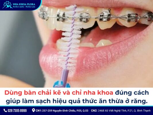 cách chăm sóc răng miệng khi niềng răng - ảnh 3 cách chăm sóc răng miệng khi niềng răng - ảnh 3