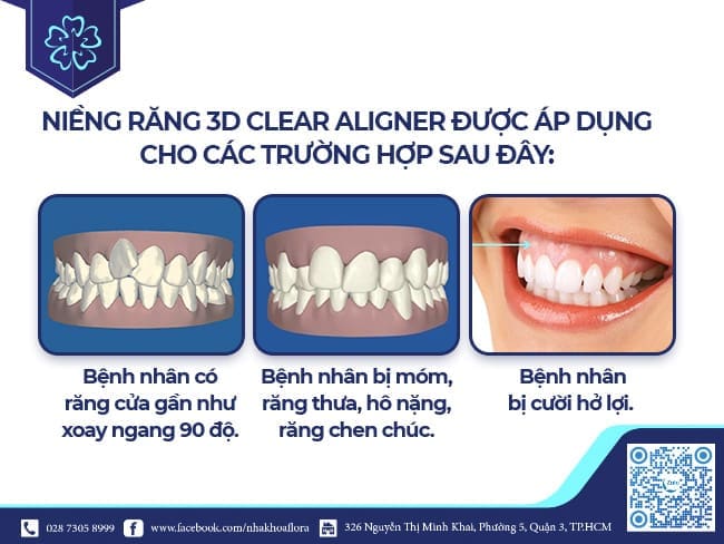 3D Clear Aligner Braces