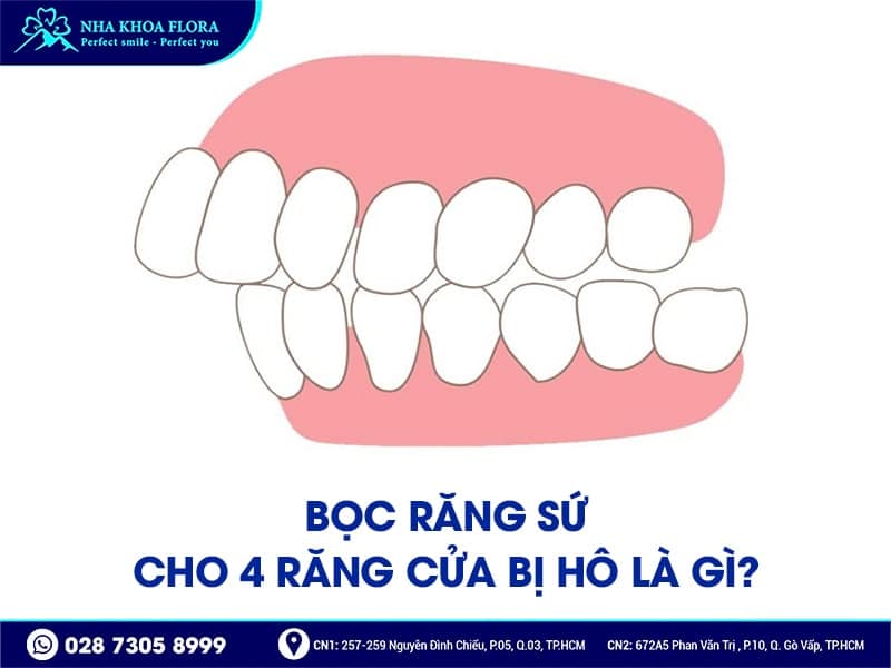Bọc răng sứ cho 4 răng cửa bị hô - ảnh 1 Bọc răng sứ cho 4 răng cửa bị hô - ảnh 1