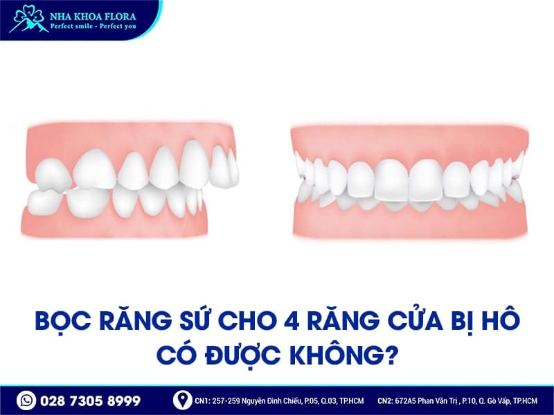 Bọc răng sứ cho 4 răng cửa bị hô - ảnh 2 Bọc răng sứ cho 4 răng cửa bị hô - ảnh 2