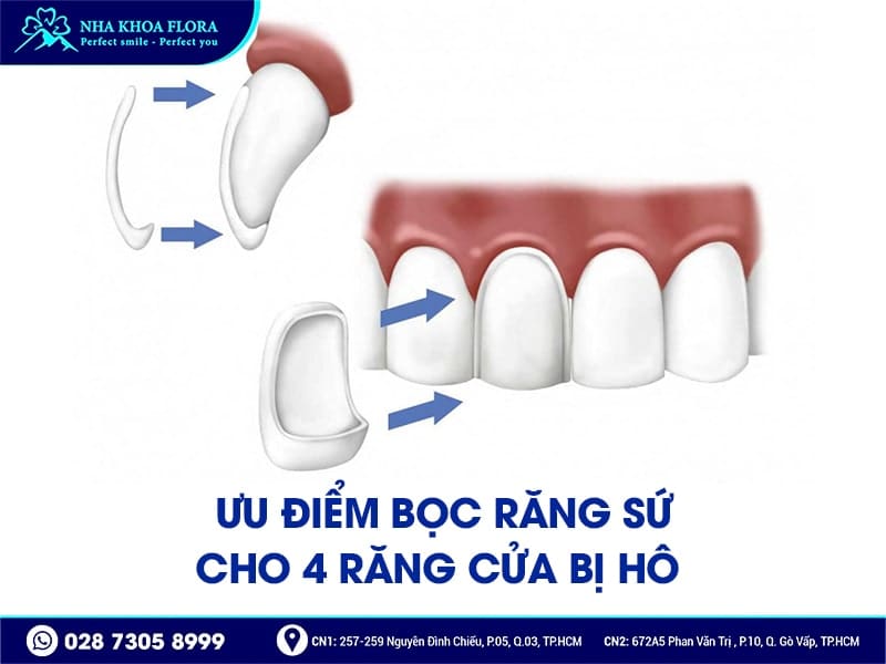 Bọc răng sứ cho 4 răng cửa bị hô - ảnh 3 Bọc răng sứ cho 4 răng cửa bị hô - ảnh 3