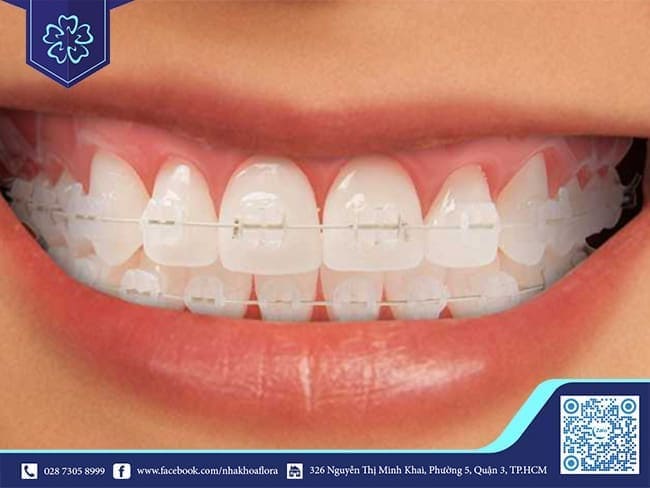 Damon braces