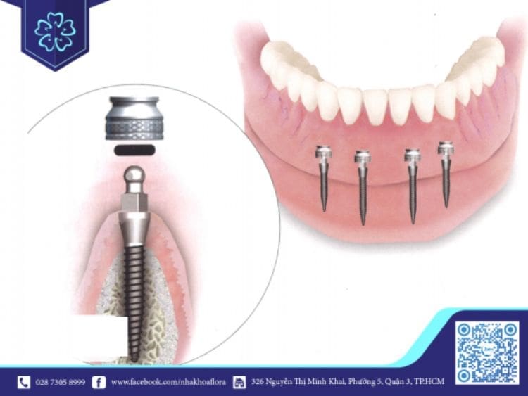 Nên cấy bao nhiêu trụ Implant trên hàm thì tốt nhất? Nên cấy bao nhiêu trụ Implant trên hàm thì tốt nhất?