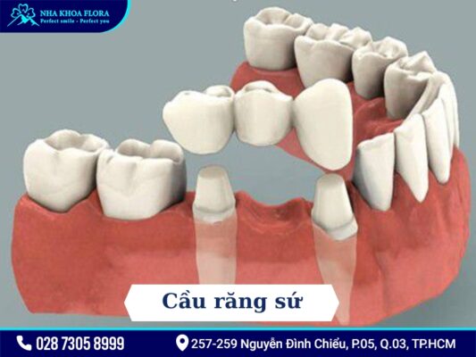 Phương pháp điều trị mất răng - ảnh 3 Phương pháp điều trị mất răng - ảnh 3