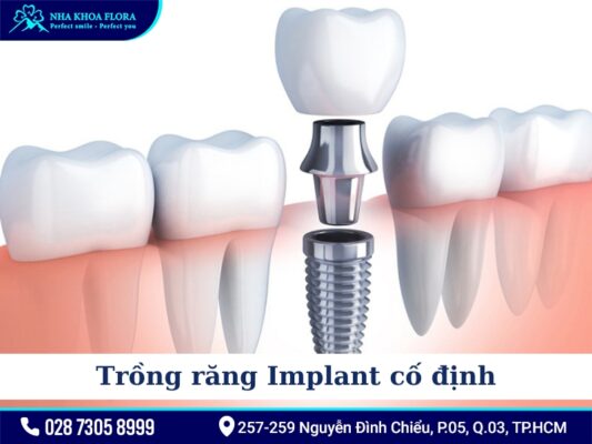Phương pháp điều trị mất răng - ảnh 4 Phương pháp điều trị mất răng - ảnh 4