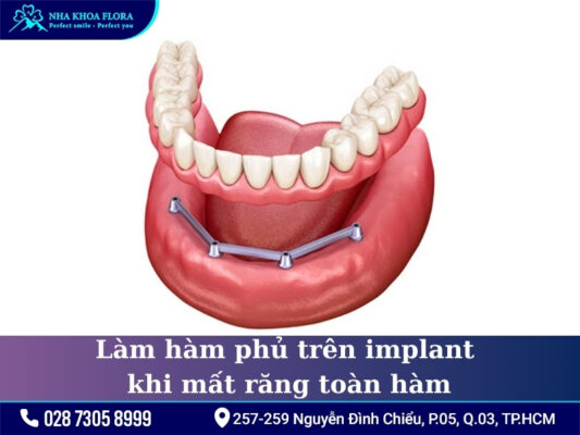 Phương pháp điều trị mất răng - ảnh 6 Phương pháp điều trị mất răng - ảnh 6