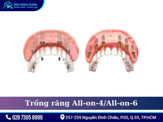 Phương pháp điều trị mất răng - ảnh 7 Phương pháp điều trị mất răng - ảnh 7