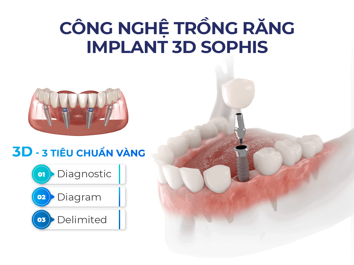 Công nghệ trồng răng 3D Sophis chuẩn Thuỵ Sỹ Công nghệ trồng răng 3D Sophis chuẩn Thuỵ Sỹ