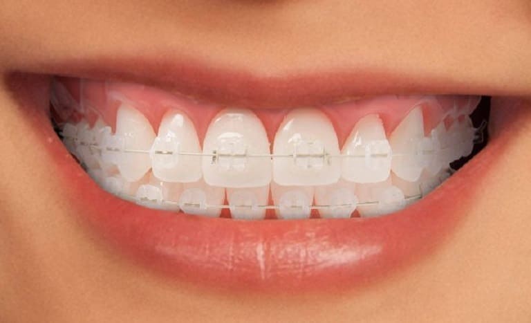 Niềng răng mắc cài sứ