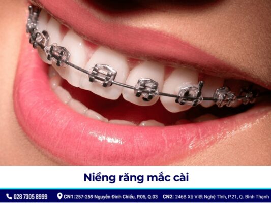 niềng răng mắc cài - ảnh 1 niềng răng mắc cài - ảnh 1