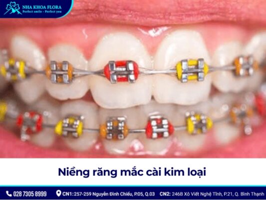 niềng răng mắc cài - ảnh 2 niềng răng mắc cài - ảnh 2