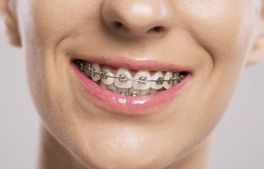 Niềng răng mắc cài là gì?