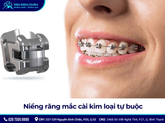 niềng răng mắc cài - ảnh 3 niềng răng mắc cài - ảnh 3