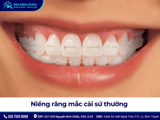 niềng răng mắc cài - ảnh 4 niềng răng mắc cài - ảnh 4