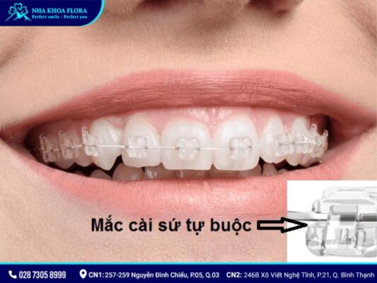 niềng răng mắc cài - ảnh 5 niềng răng mắc cài - ảnh 5