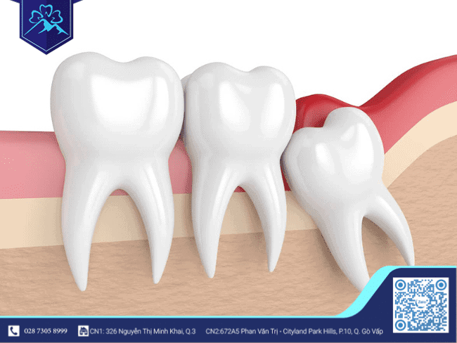 Ứng dụng công nghệ PRF trong nhổ răng khôn - ảnh 2 Ứng dụng công nghệ PRF trong nhổ răng khôn - ảnh 2