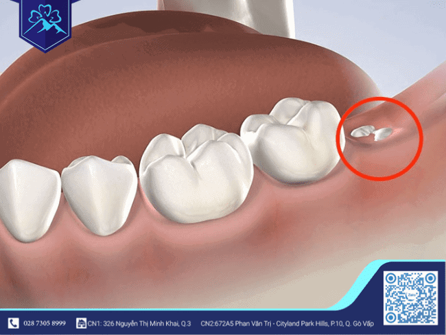 Ứng dụng công nghệ PRF trong nhổ răng khôn - ảnh 1 Ứng dụng công nghệ PRF trong nhổ răng khôn - ảnh 1