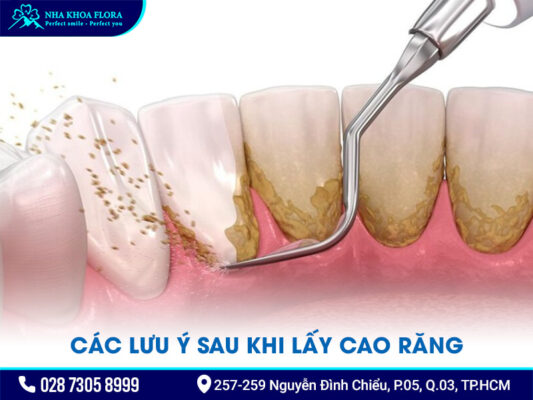 Lưu ý sau khi lấy cao răng - ảnh 1 Lưu ý sau khi lấy cao răng - ảnh 1