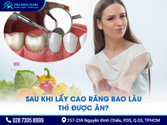 Lưu ý sau khi lấy cao răng - ảnh 3 Lưu ý sau khi lấy cao răng - ảnh 3
