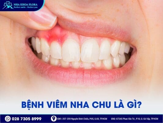 Viêm nha chu - ảnh 1 Viêm nha chu - ảnh 1
