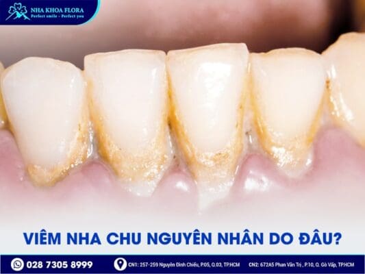 Viêm nha chu - ảnh 3 Viêm nha chu - ảnh 3