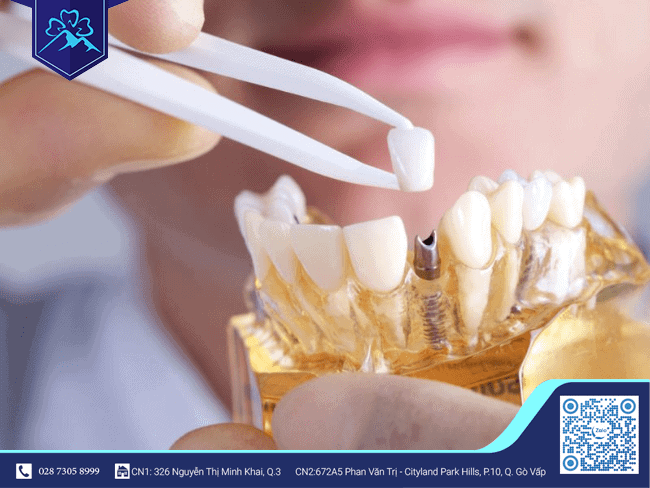 Răng tạm trên Implant Răng tạm trên Implant