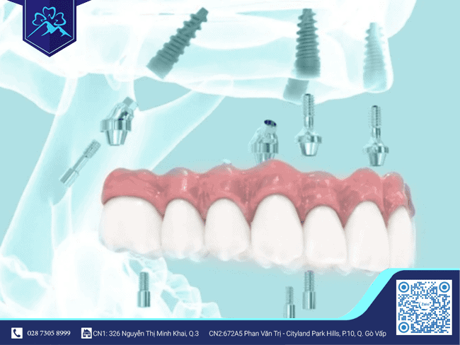 Implant sẽ có đủ khả năng chịu lực sang chấn Implant sẽ có đủ khả năng chịu lực sang chấn