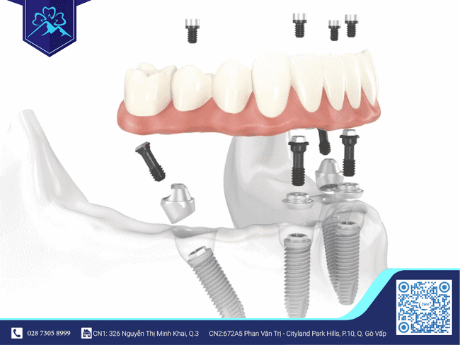 Trồng răng Implant khắc phục tình trạng mất răng liền kề Trồng răng Implant khắc phục tình trạng mất răng liền kề