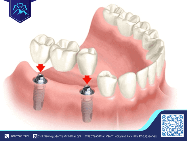 Mất 3 răng liền kề chỉ cần cấy 2 trụ Implant Mất 3 răng liền kề chỉ cần cấy 2 trụ Implant