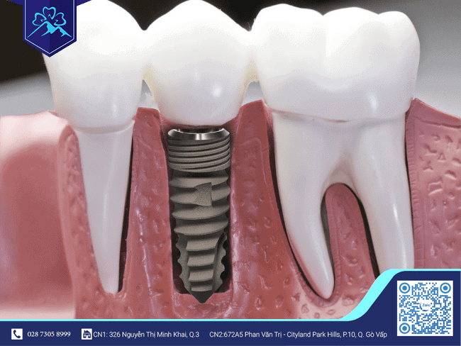 Trồng răng Implant đón tết Trồng răng Implant đón tết