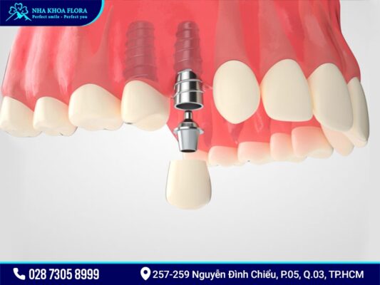 Sau khi sinh bao lâu thì trồng răng Implant được? - ảnh 1 Sau khi sinh bao lâu thì trồng răng Implant được? - ảnh 1