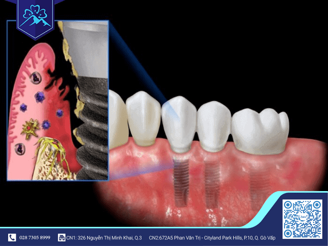 Triệu chứng nhiễm trùng sau khi cấy ghép Implant Triệu chứng nhiễm trùng sau khi cấy ghép Implant