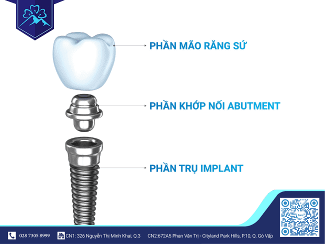 Cấu tạo của răng Implant Cấu tạo của răng Implant