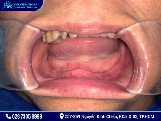 Implant All On 4 và All On 6 - ảnh 1 Implant All On 4 và All On 6 - ảnh 1