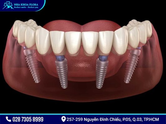 Implant All On 4 và All On 6 - ảnh 2 Implant All On 4 và All On 6 - ảnh 2