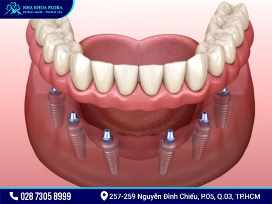 Implant All On 4 và All On 6 - ảnh 3 Implant All On 4 và All On 6 - ảnh 3