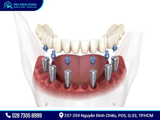 Implant All On 4 và All On 6 - ảnh 4 Implant All On 4 và All On 6 - ảnh 4