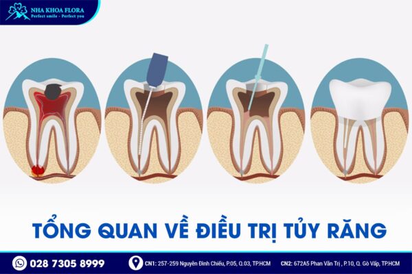 điều trị tủy có đau không - ảnh 1 điều trị tủy có đau không - ảnh 1