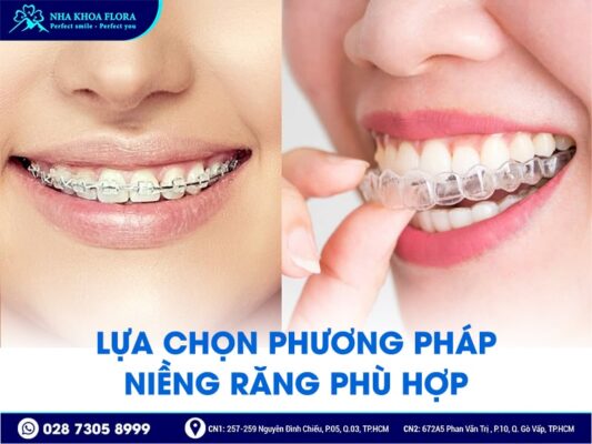 lưu ý khi niềng răng - ảnh 1 lưu ý khi niềng răng - ảnh 1