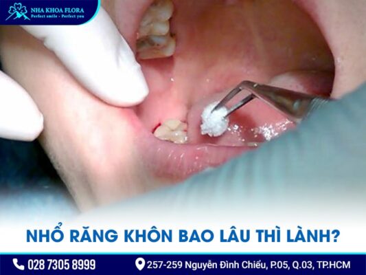 nhổ răng khôn bao lâu thì lành - ảnh 1 nhổ răng khôn bao lâu thì lành - ảnh 1