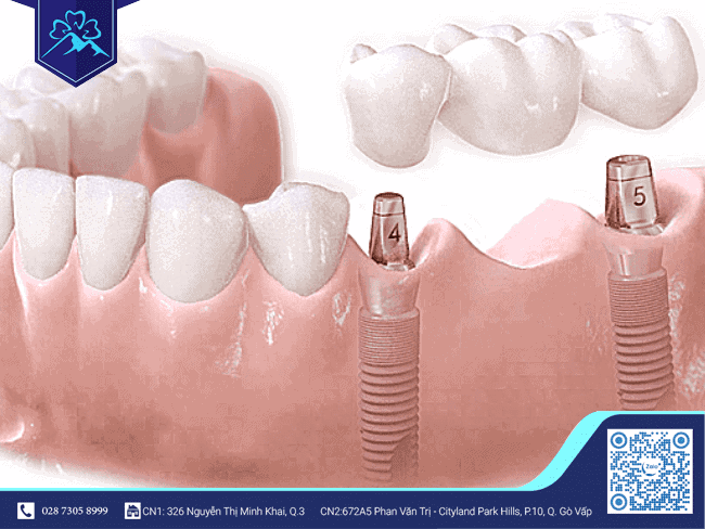 Có thể thay mới răng sứ trên Implant Có thể thay mới răng sứ trên Implant