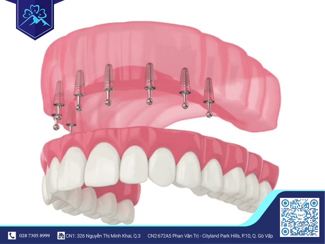 Cấu tạo của trụ Implant Cấu tạo của trụ Implant