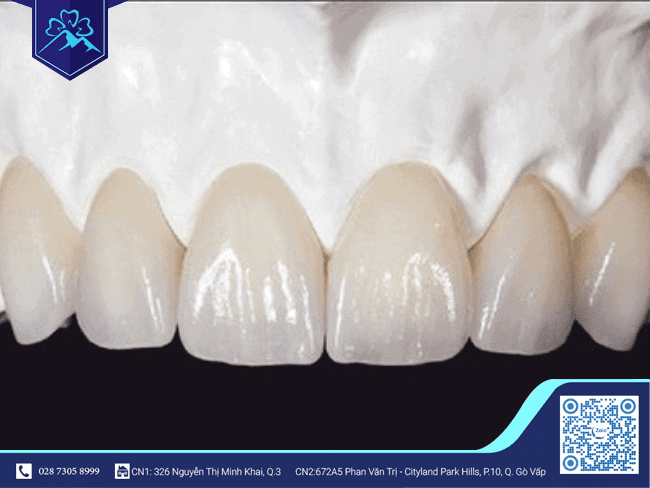 Răng sứ Zirconia Răng sứ Zirconia