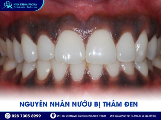 làm hồng nướu bằng Laser - ảnh 1 làm hồng nướu bằng Laser - ảnh 1