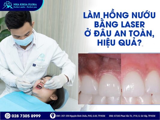 làm hồng nướu bằng Laser - ảnh 4 làm hồng nướu bằng Laser - ảnh 4