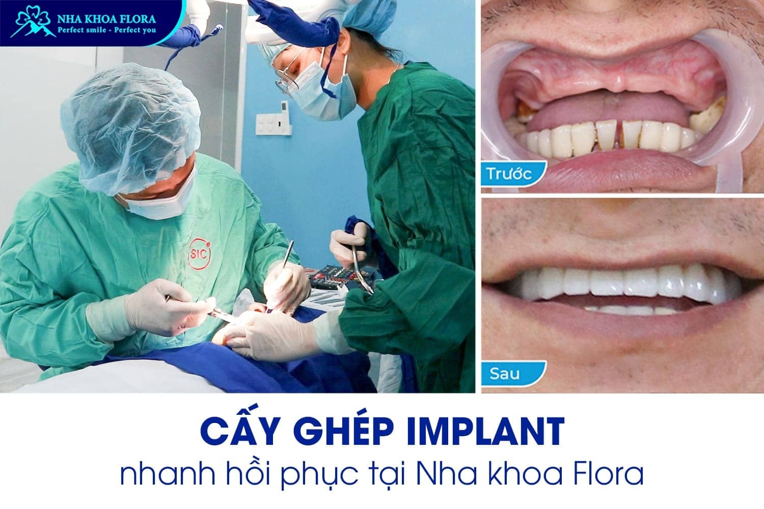 Hỏi Đáp: Trồng Răng Implant Bao Lâu Thì Lành? - ảnh 5 Hỏi Đáp: Trồng Răng Implant Bao Lâu Thì Lành? - ảnh 5