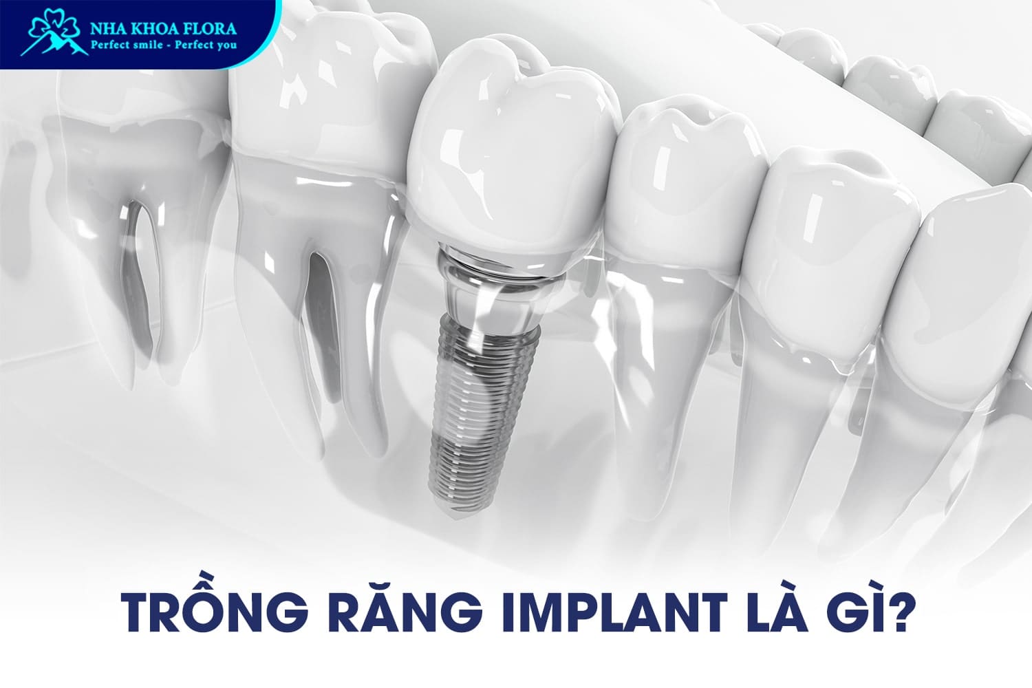 Trồng Răng Implant Có Niềng Răng Được Không? - ảnh 1 Trồng Răng Implant Có Niềng Răng Được Không? - ảnh 1