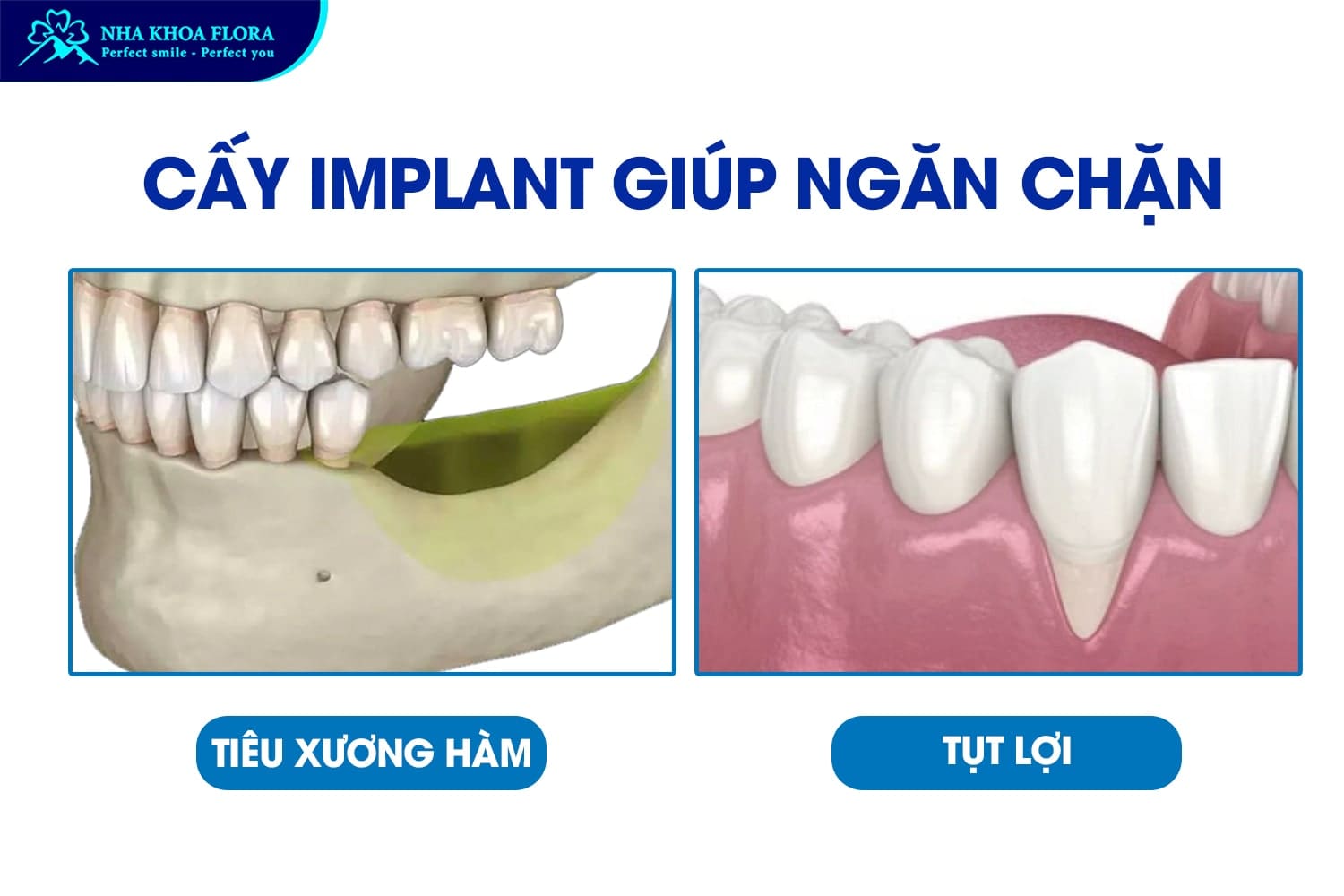 Hỏi Đáp: Trồng Răng Implant Có Vĩnh Viễn Không? - ảnh 2 Hỏi Đáp: Trồng Răng Implant Có Vĩnh Viễn Không? - ảnh 2